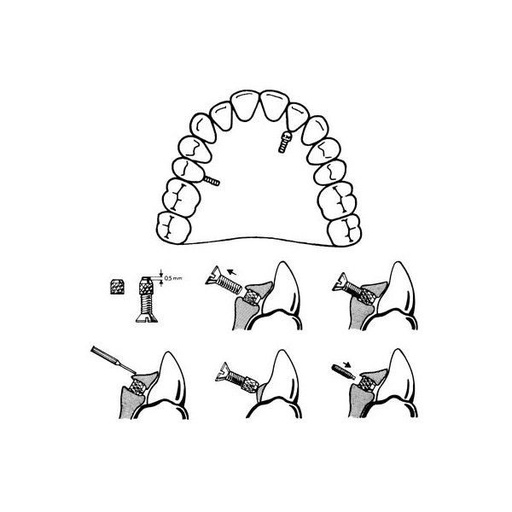 [LE0521] A0668-95 KIT MICRO TORNILLO C/RESORTE A.INOXIDABLE