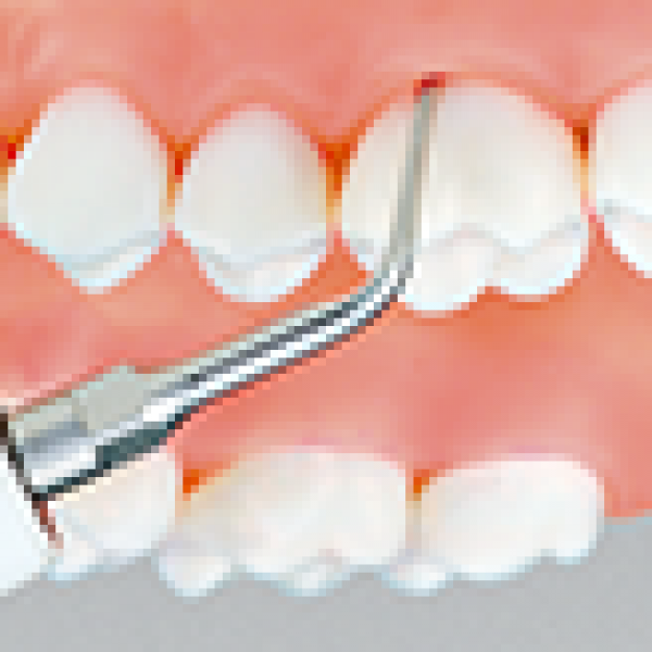 G8 PUNTA: ESCARIFICACIÓN